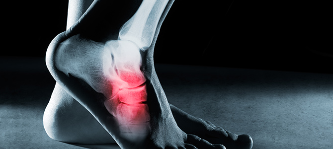 Osteoarthritis