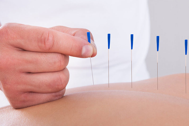 Acupuncture